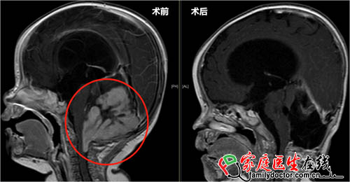 心疼！5月女婴脑部患癌 肿瘤大若拳头