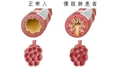 “沉默”慢阻肺为什么老是反反复复治不好？应该怎样护理？