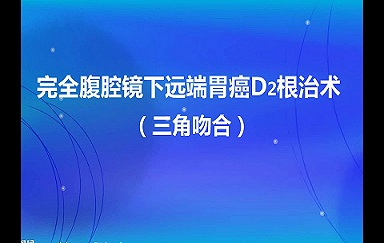 完全腹腔镜远端胃癌D2根治术+三角吻合