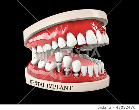 3d illustration of Human teeth and Dental implant isolated black 45092476