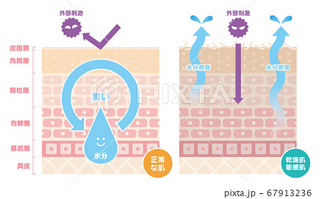 正常な肌と乾燥肌、敏感肌を比較した肌の断面図、イラスト 67913236