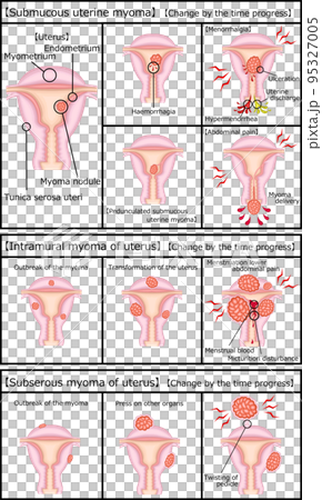 子宮筋腫の種類と経過　イラスト　英語 95327005