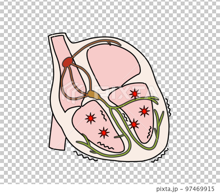 ventricular fibrillation 97469915