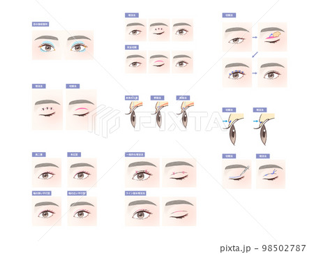 目の整形図解セット 98502787