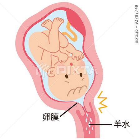 前期破水　子宮の中の赤ちゃん　妊娠中の母体の仕組み 92783749