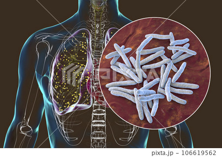 Human lungs affected by miliary tuberculosis, with a close-up view of the Mycobacterium tuberculosis bacteria, 3D illustration 106619562