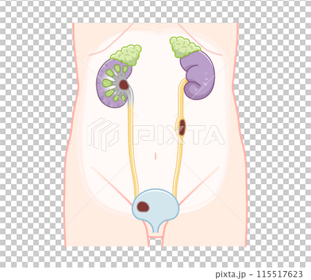 Kidney, ureter, bladder, kidney cancer, renal pelvis cancer, cancer, ureter cancer, bladder cancer, illustration 115517623