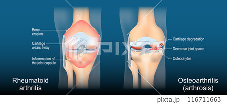 Rheumatoid arthritis and Osteoarthritis. Comparison between a Arthrosis and  RA joints 116711663