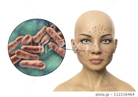 Acne vulgaris on skin and closeup view of bacteria 112216464