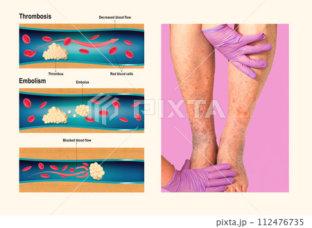 Deep Vein Thrombosis or Blood Clots. Embolus. 112476735