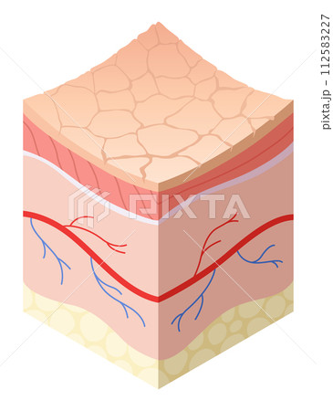 Skincare medical concept. Problems in cross-section of human skin horizontal layers structure. Anatomy illustrative model unhealthy layer of skin 112583227