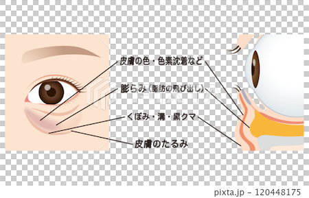 目の下のたるみ　たるんだ下まぶた 120448175