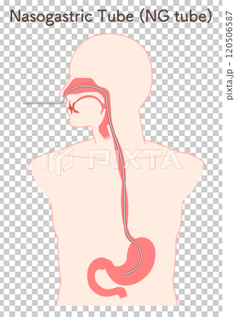 Gastric drainage, nasogastric tube 120506587