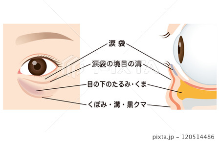 目の下のたるみ　たるんだ下まぶた 120514486