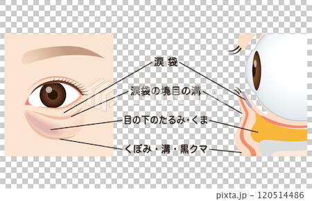 目の下のたるみ　たるんだ下まぶた 120514486