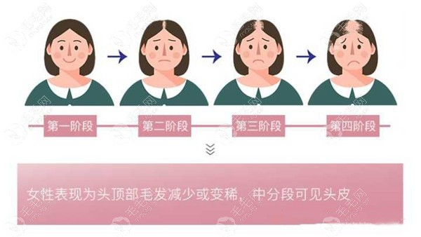 分享女性头顶头发加密日记,想改善顶部头发稀少的亲可来看