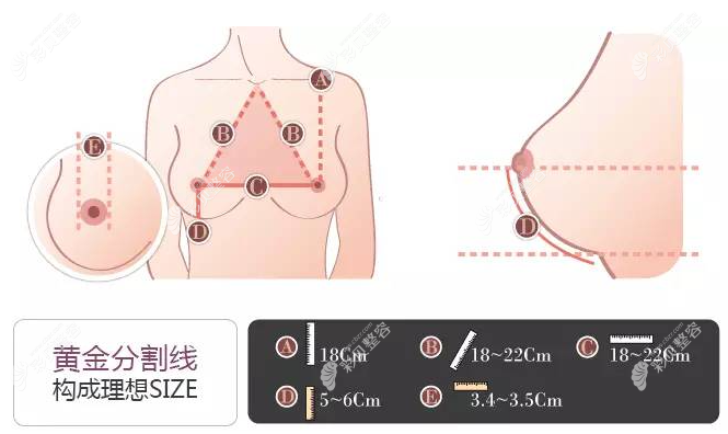 做了魔滴motiva假体隆胸400cc没多久就变柔软了