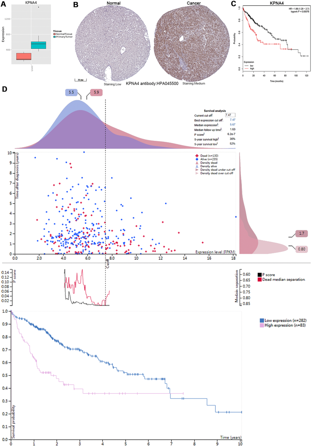 KPNA4’s expression and prognostic value in HCC patients. (A) The mRNA expression level of KPNA4 was significantly higher in cancerous tissues than in normal tissues in the Metabolic gEne RApid Visualizer. (B) Representative immunohistochemistry images from the HPA with the KPNA4 antibody: HPA045500, cancerous tissue had higher staining than normal liver tissue. (C) High KPNA4 mRNA expression was significantly associated with poor OS in HCC patients from the Kaplan-Meier plotter. (D) Prognostic value of the KPNA4 level in HCC patients from the HPA.