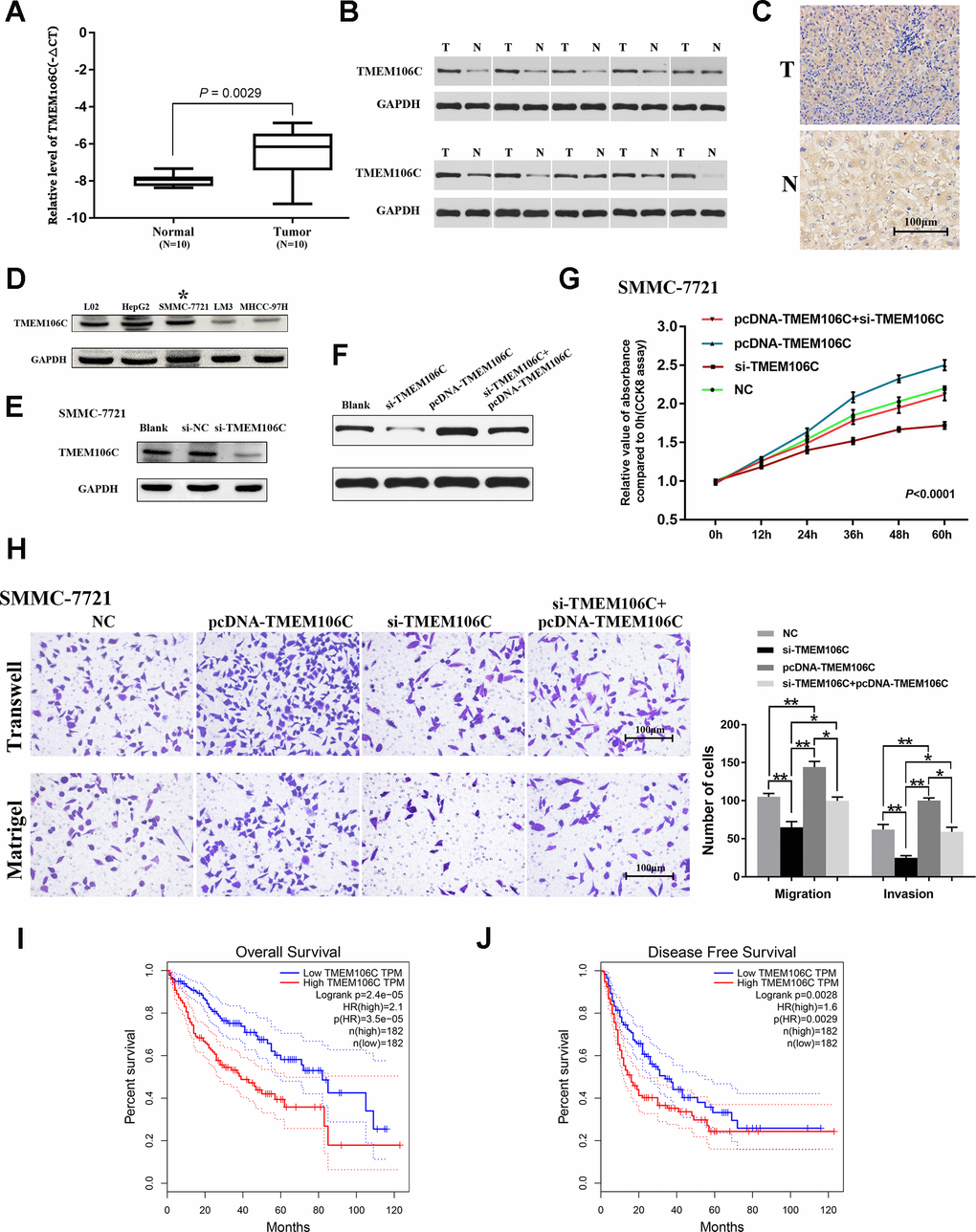 Expression validation, functional exploration and prognostic value of TMEM106C in HCC. (A) Relative expression level of TMEM106C in 10 pairs of HCC samples (tumor tissues and adjacent normal liver tissues), as assessed by real-time PCR. (B) The protein expression level of TMEM106C in 10 pairs of HCC samples, as assessed by western blot. (C) TMEM106C IHC staining in HCC and adjacent normal liver tissue. 400×. (D) The protein expression level of TMEM106C in the normal liver cell line L02 and in different HCC cell lines. The cell line SMMC-7721 was selected for further study. (E) siRNAs targeting TMEM106C were transfected into SMMC-7721 cells for 48 h, and then all cell lysates were harvested for western blotting. (F) TMEM106C levels under si-TMEM106C, pcDNA-TMEM106C plasmid or si-TMEM106C plus pcDNA-TMEM106C plasmid assessed by western blot. (G) si-TMEM106C (50 nM) and pcDNA-TMEM106C plasmid plus si-TMEM106C were transfected into SMMC-7721 cells and were compared to untransfected control cells. Every 12 h, cell numbers were measured by CCK8 assay. NC represents pcDNA3.1, si-NC, and blank control, which were proven to not be different from each other. P H) Transwell migration and invasion assays of SMMC-7721 cells after transient transfection with si-TMEM106C or pcDNA-TMEM106C plasmid plus si-TMEM106C or not. The migration and invasion cell numbers are shown in histograms (mean ± SD). NC represents pcDNA3.1, si-NC, and blank control, which were proven to not be different from each other. 400×. *P P I) The overall survival rates of 364 HCC patients were compared between the TMEM106C high and low expression groups using Kaplan-Meier analysis (GEPIA). (J) The disease-free survival rates of 364 HCC patients were compared between the TMEM106C high and low expression groups using Kaplan-Meier analysis (GEPIA).