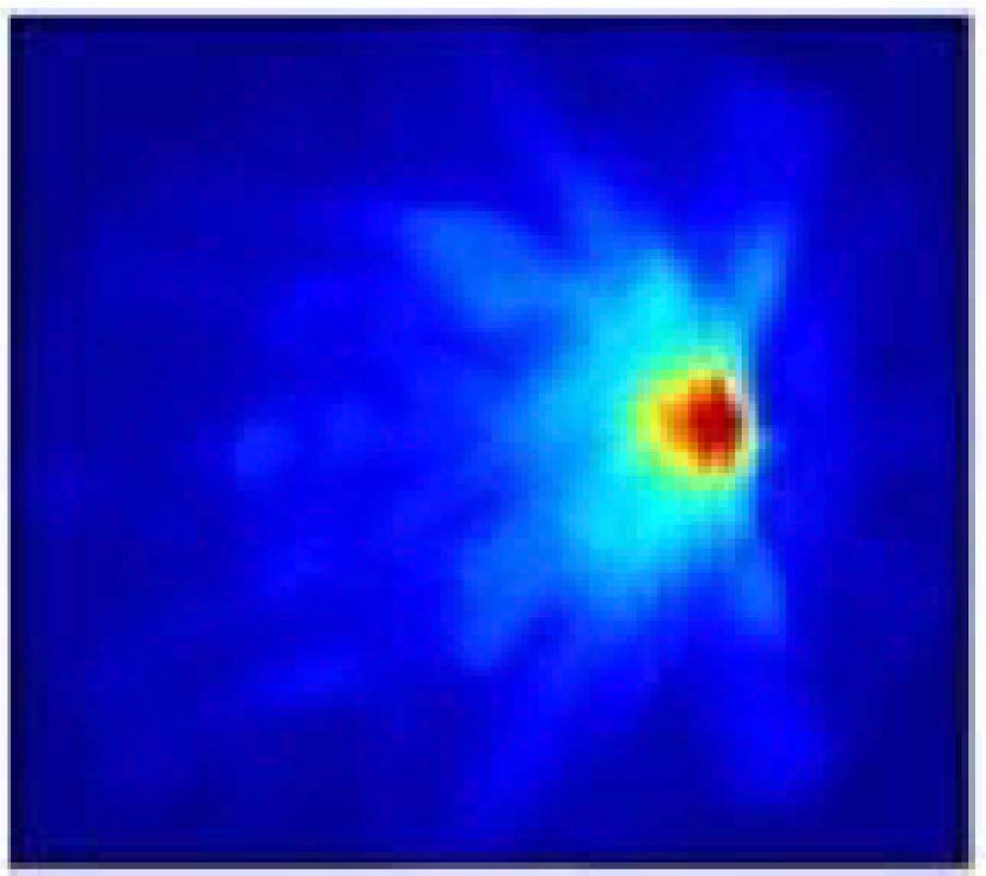 RADAR SENSING FEATURING BICONICAL ANTENNA AND ENHANCED DELAY AND SUM ALGORITHM FOR EARLY STAGE BREAST CANCER DETECTION