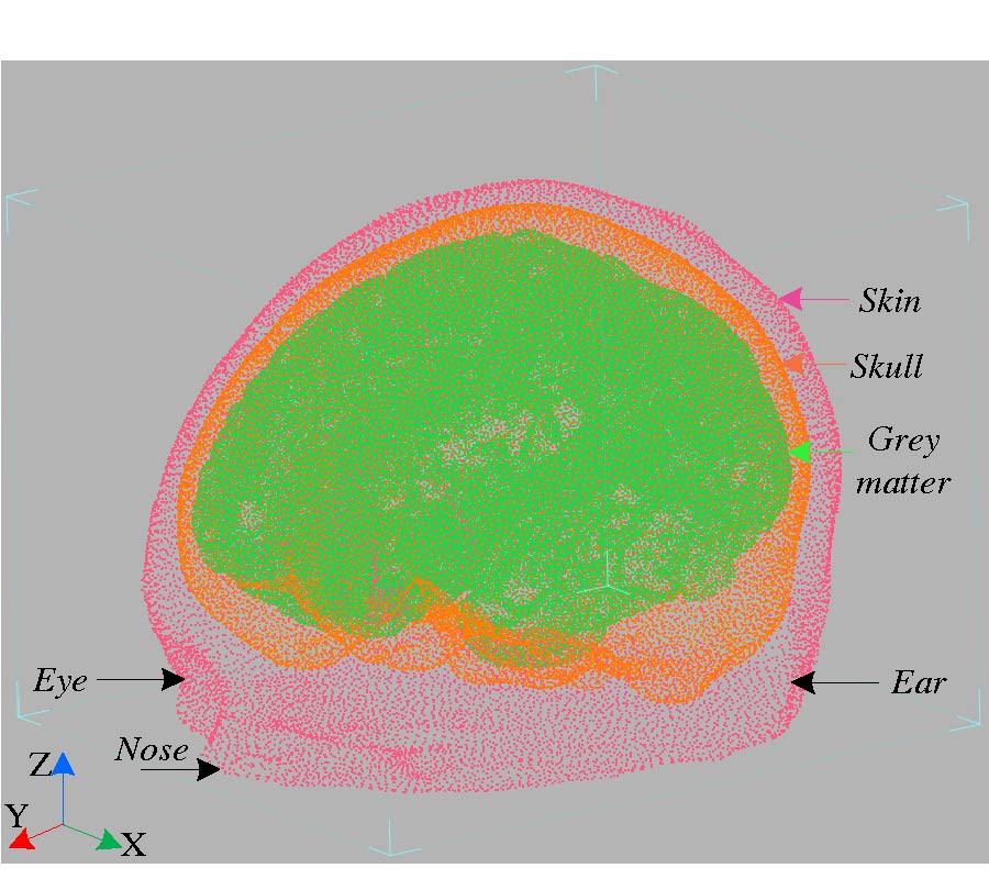 FOCALIZED BRAIN TRANSCRANIAL MAGNETIC STIMULATION WITH THE UTILIZATION OF A FIELD SHAPER AND A CRESCENT FERROMAGNETIC CORE