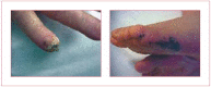 Figure 1. Osler's nodes on a finger and foot.