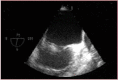 Figure 2. Mitral valve vegetation.