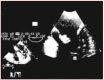 Figure 3. Transesophageal echo for 1 mm lesions.