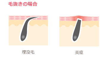 毛抜きで皮膚を傷めたイメージ