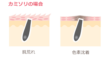 カミソリ負けしたイメージ