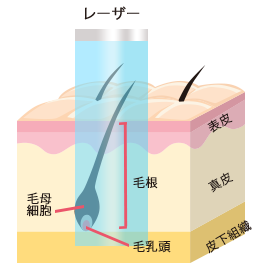 医療レーザー脱毛