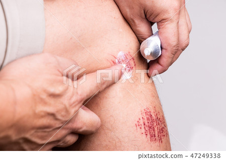 Person apply antiseptic cream onto painful wound. 47249338