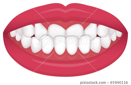 Types of teeth alignment, dentition, malocclusion Vector illustration / Mandibular anterior protrusion (receptacle) 65940116