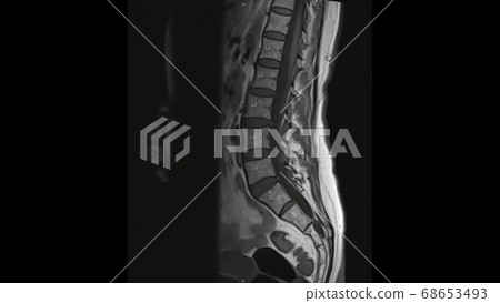 Magnetic Resonance images of Lumbar spine sagittal T1-weighted images  (MRI Lumbar spine) showing mild disc disease. 68653493