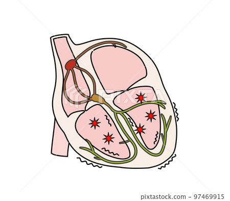 ventricular fibrillation 97469915