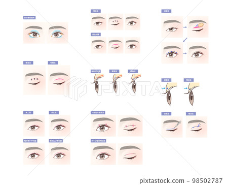 eye surgery illustration set 98502787