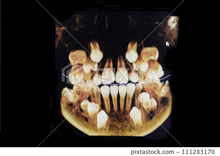 CT image of the teeth of a 9-year-old child, with baby teeth, in different projections. CBCT of two jaws. 111283170