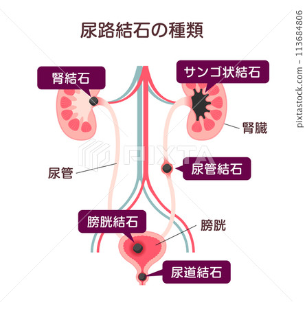 Types of urinary stones Vector illustration 113684806