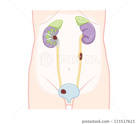 Kidney, ureter, bladder, kidney cancer, renal pelvis cancer, cancer, ureter cancer, bladder cancer, illustration 115517623