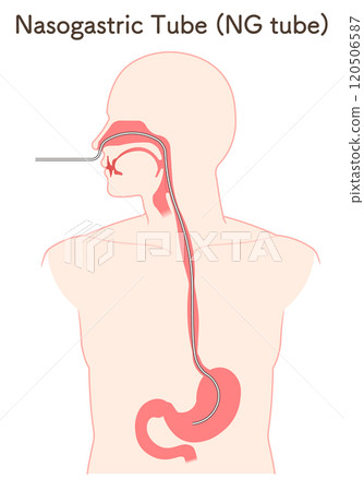 Gastric drainage, nasogastric tube 120506587