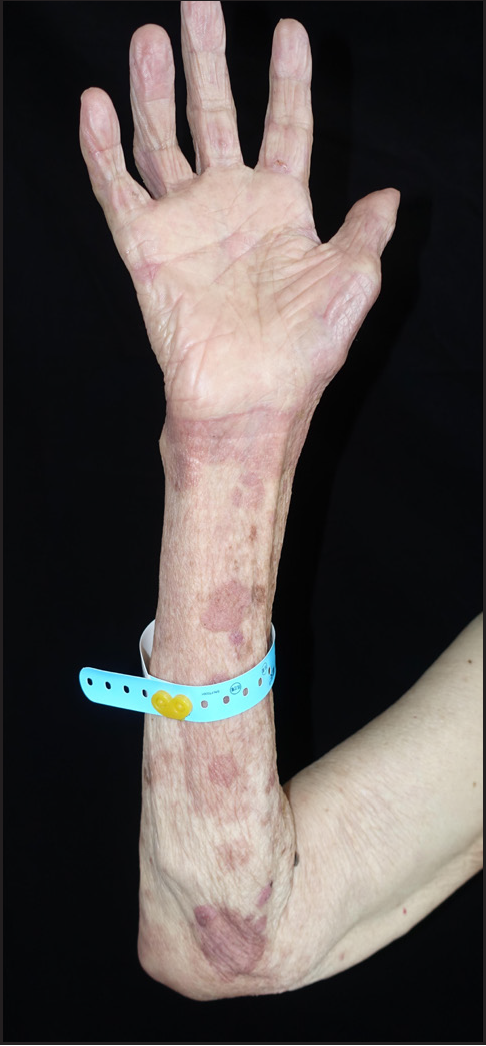 Blisters and bullae on the forearms are dry after 4 courses of dupilumab therapy in patient 2