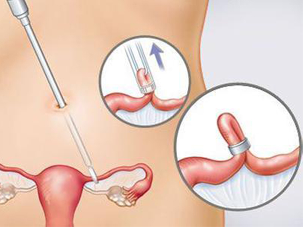 输卵管结扎后应先复通