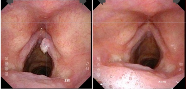 声音嘶哑不愈竟是因为长在“生命要道”上的癌症，专家呼吁出现5大症状要及时就医