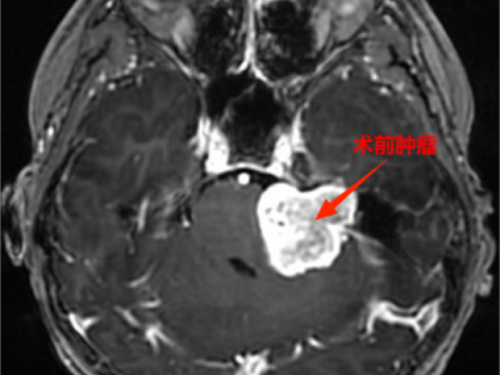 听力下降竟是脑内长了瘤 广州医生高难度手术摘除病灶
