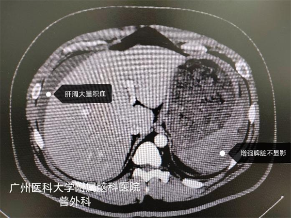 骑车摔破脾脏险丢命，紧急抢救输血获新生