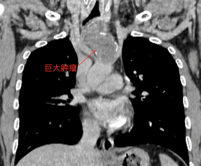 小伙胸骨长拳头大肿瘤，气管被压成一条缝！ 广医三院多学科专家团队救治罕见巨大胸壁肿瘤患者