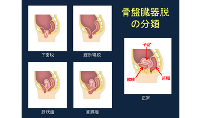 ひとりで悩まず受診を～骨盤臓器脱～