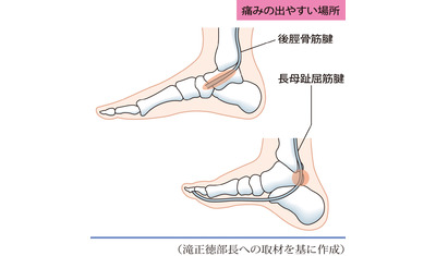 足にも起こる腱鞘炎～大人の扁平足は要注意（聖隷浜松病院　滝正徳部長）～