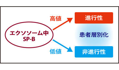 進行を予測する指標発見～間質性肺炎の早期治療で（大阪大学大学院　榎本貴俊医師ら）～