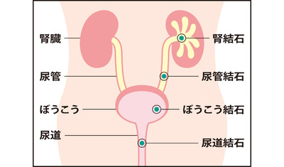 尿路結石の予防法～食習慣変えリスク下げる（順天堂大学　磯谷周治准教授）～